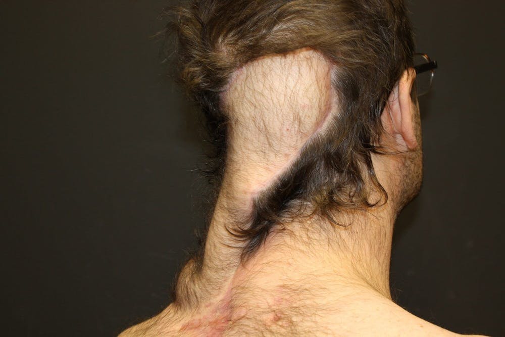 Pressure Sore Reconstruction Before & After Gallery - Patient 5800034 - Image 10