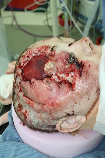 Skull Reconstruction & Cranioplasty Before & After Gallery - Patient 5800190 - Image 2