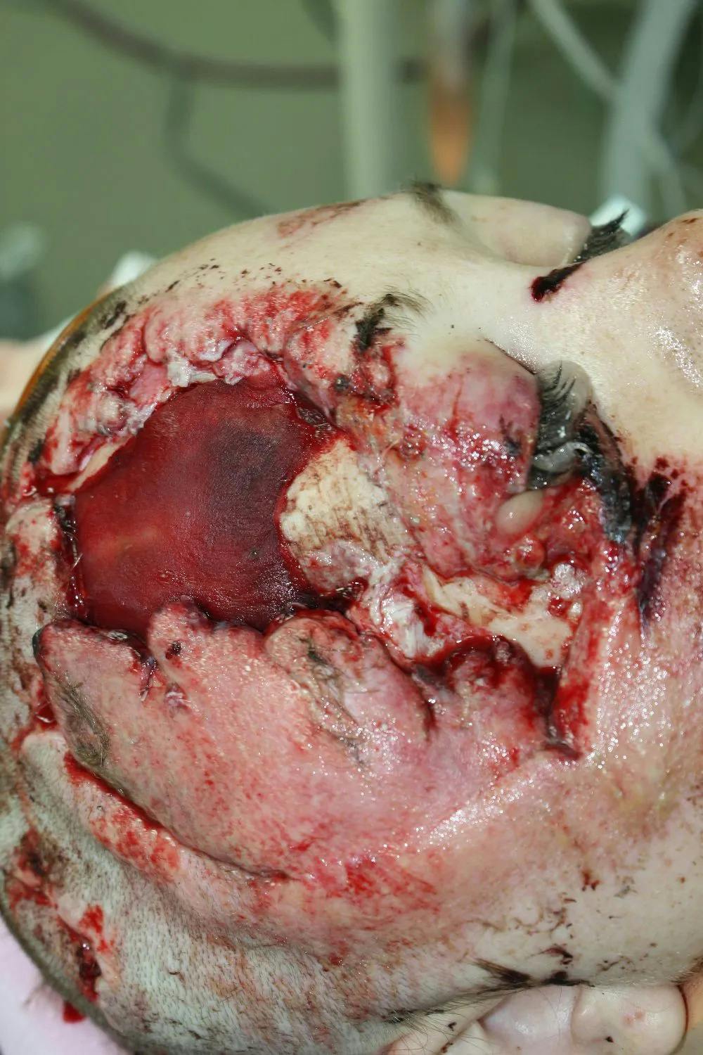 Skull Reconstruction & Cranioplasty Before & After Gallery - Patient 5800190 - Image 3