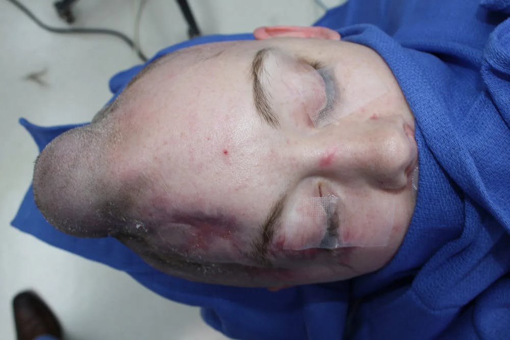 Skull Reconstruction & Cranioplasty Before & After Gallery - Patient 5800190 - Image 13