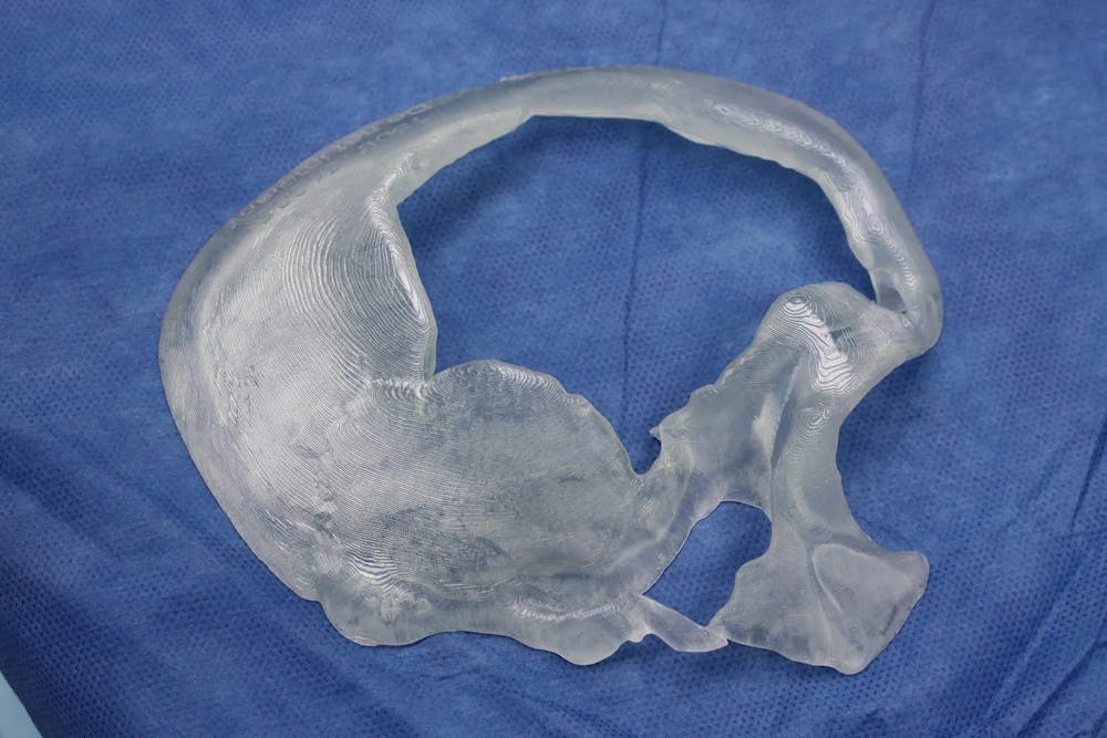 Skull Reconstruction & Cranioplasty Before & After Gallery - Patient 5800190 - Image 15