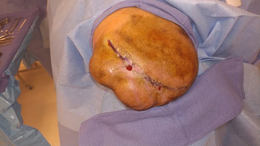 Skull Reconstruction & Cranioplasty Before & After Gallery - Patient 5800194 - Image 1