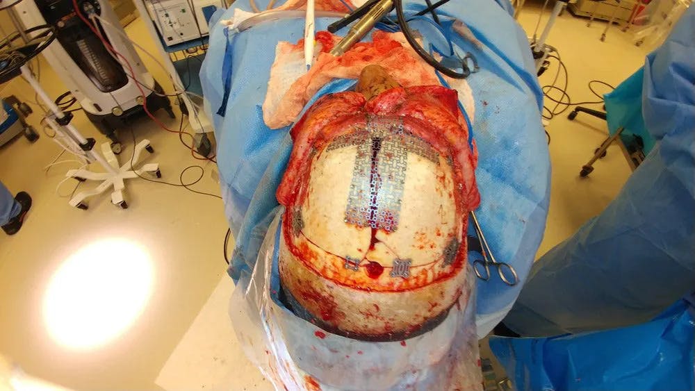Skull Reconstruction & Cranioplasty Gallery - Patient 5800195 - Image 1