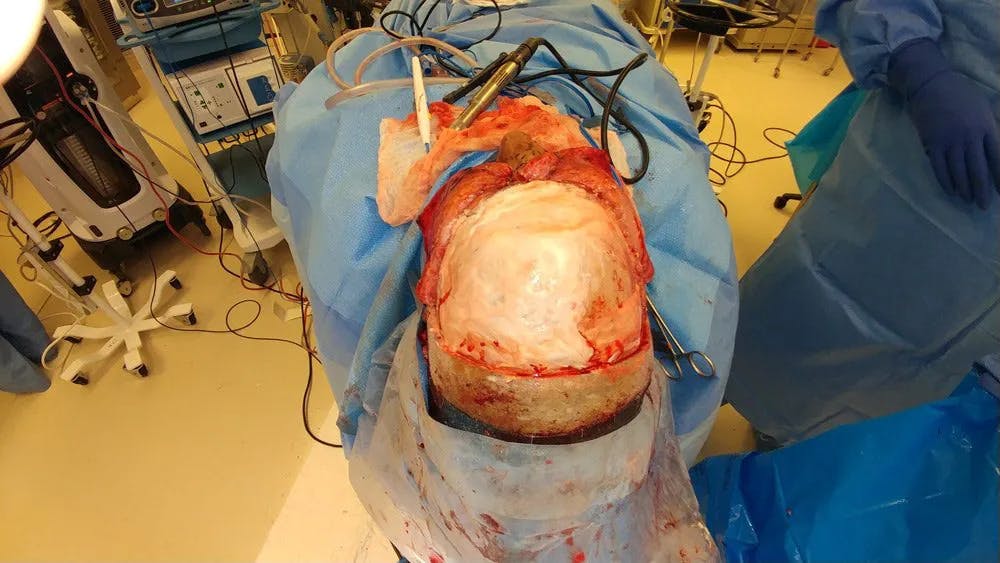 Skull Reconstruction & Cranioplasty Gallery - Patient 5800195 - Image 3