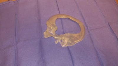 Skull Reconstruction & Cranioplasty Before & After Gallery - Patient 5800196 - Image 2