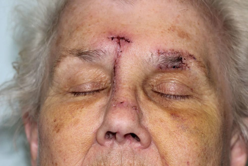 Facial and MOHS Reconstruction Before & After Gallery - Patient 5800729 - Image 1