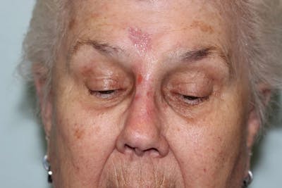 Facial and MOHS Reconstruction Before & After Gallery - Patient 5800729 - Image 2