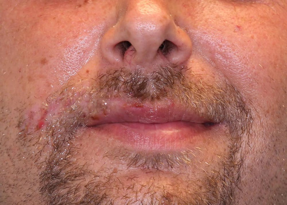 Facial and MOHS Reconstruction Before & After Gallery - Patient 5800731 - Image 5