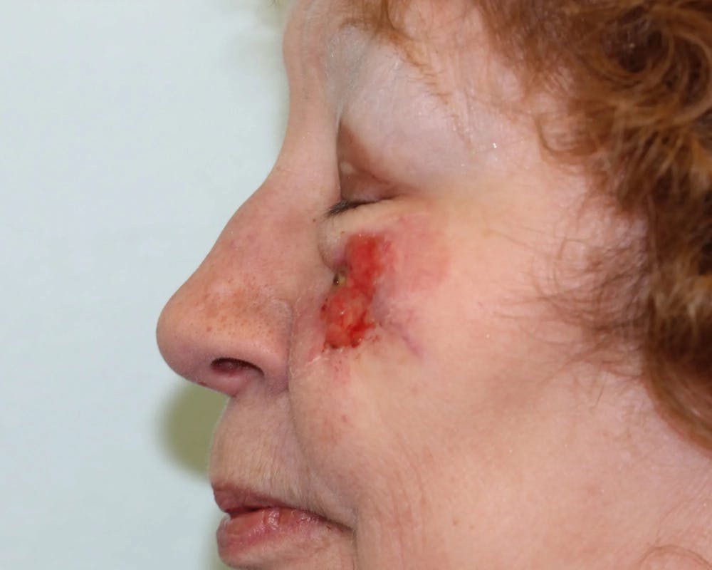 Facial and MOHS Reconstruction Before & After Gallery - Patient 5800732 - Image 3