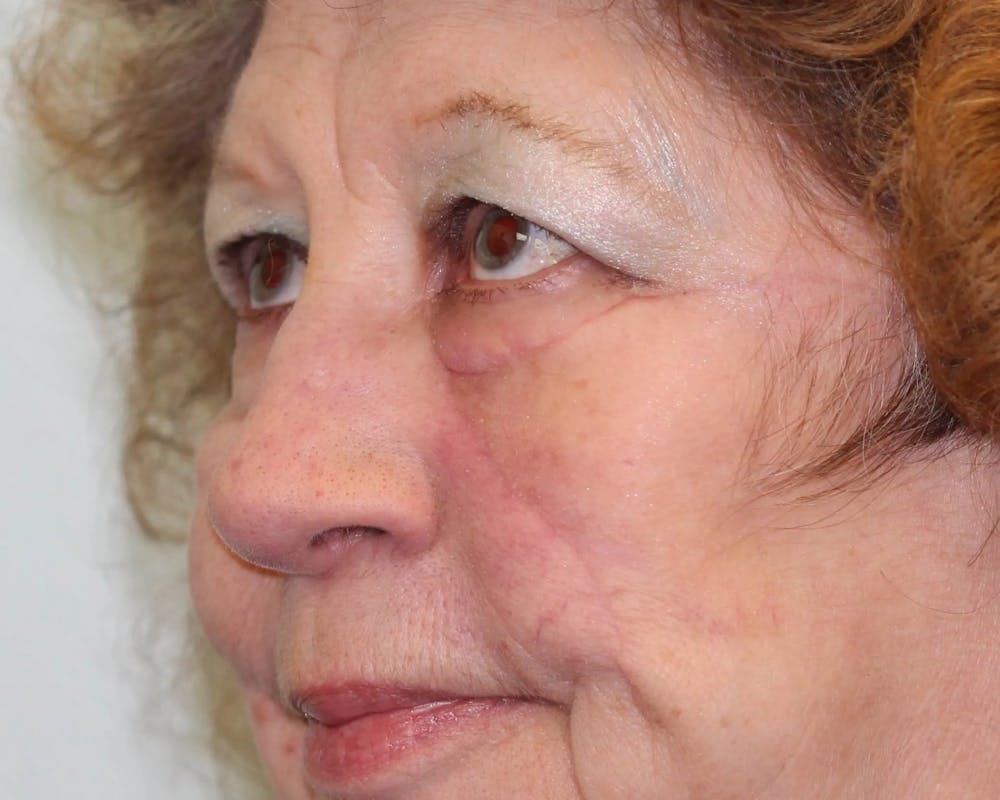 Facial and MOHS Reconstruction Before & After Gallery - Patient 5800732 - Image 5