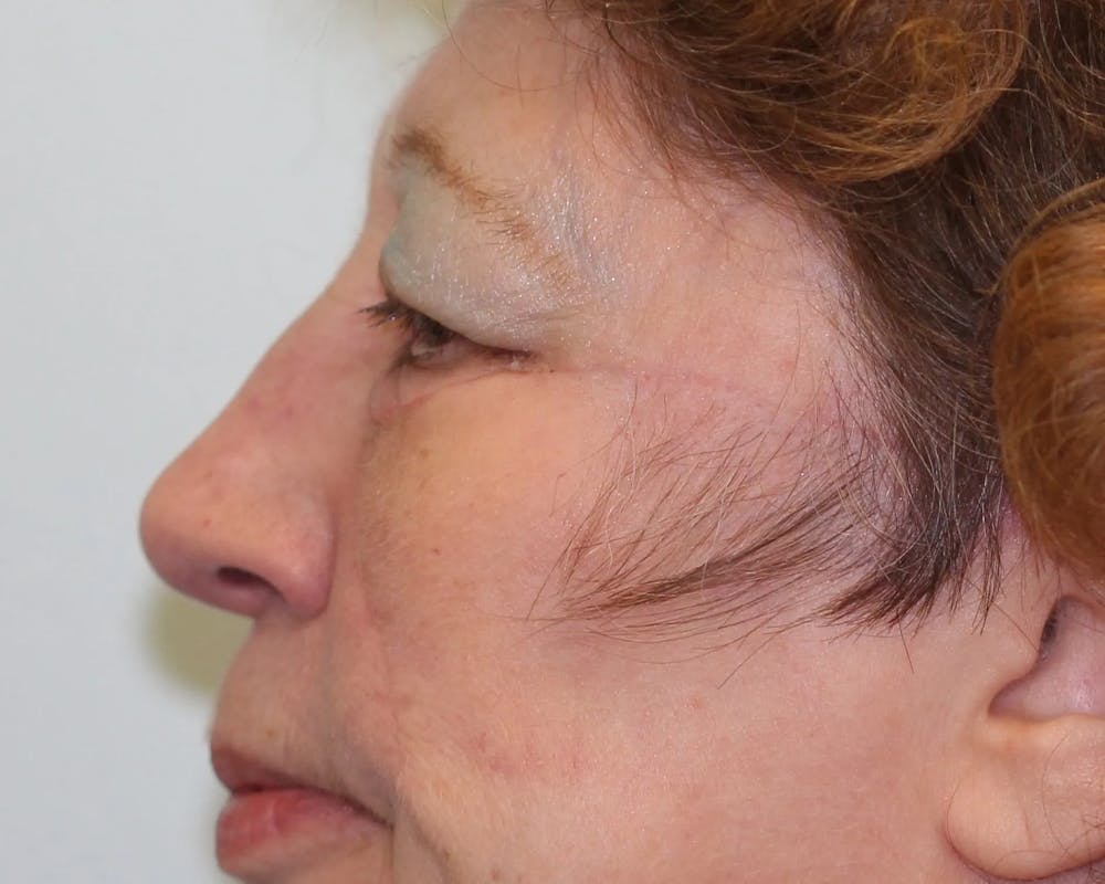 Facial and MOHS Reconstruction Before & After Gallery - Patient 5800732 - Image 6