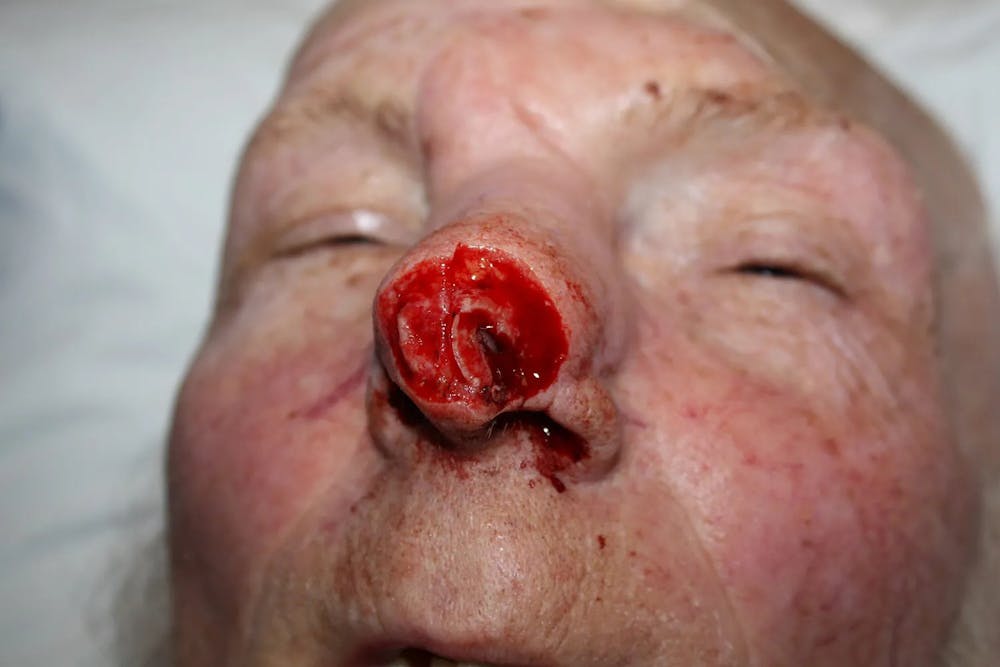 Facial and MOHS Reconstruction Before & After Gallery - Patient 5800755 - Image 2