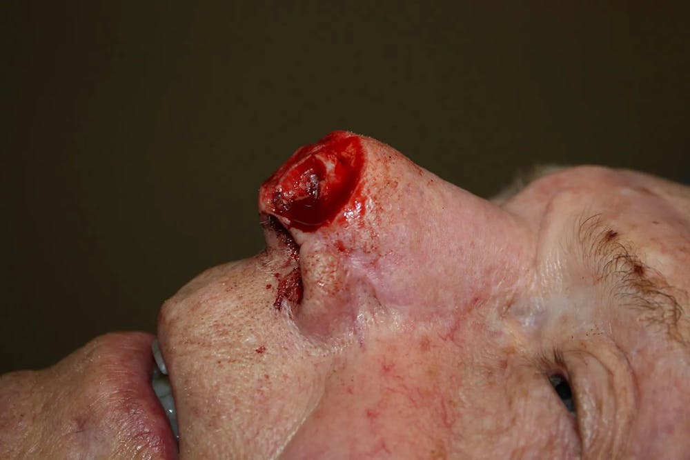 Facial and MOHS Reconstruction Before & After Gallery - Patient 5800755 - Image 3