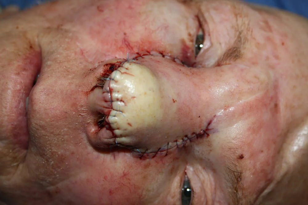 Facial and MOHS Reconstruction Before & After Gallery - Patient 5800755 - Image 4
