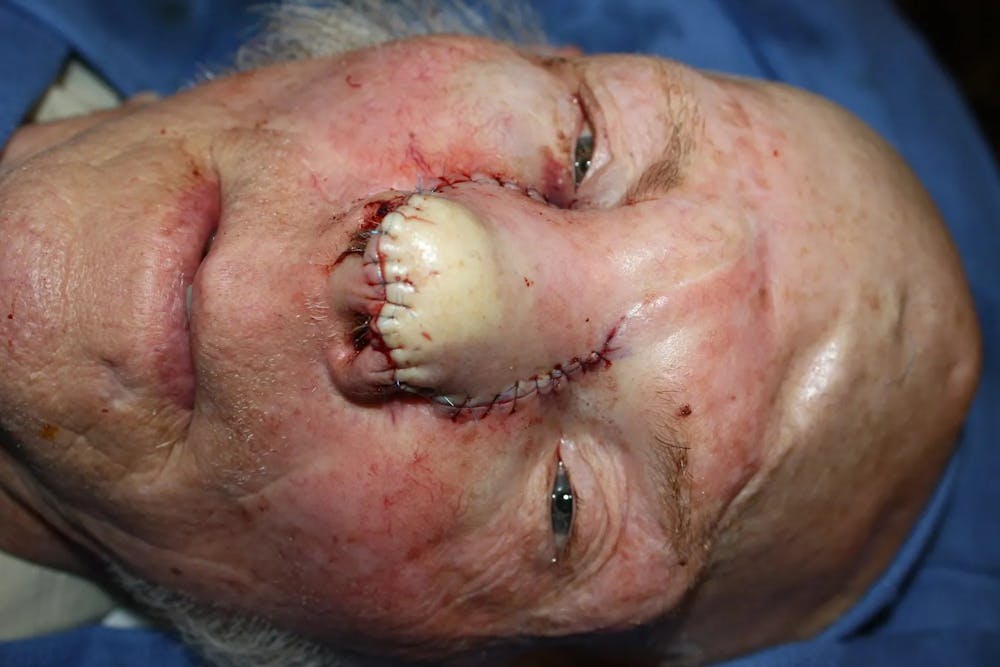 Facial and MOHS Reconstruction Before & After Gallery - Patient 5800755 - Image 5