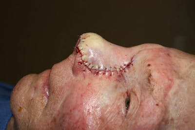 Facial and MOHS Reconstruction Before & After Gallery - Patient 5800755 - Image 6