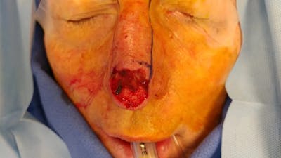 Facial and MOHS Reconstruction Before & After Gallery - Patient 5800756 - Image 1