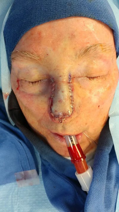 Facial and MOHS Reconstruction Before & After Gallery - Patient 5800756 - Image 2