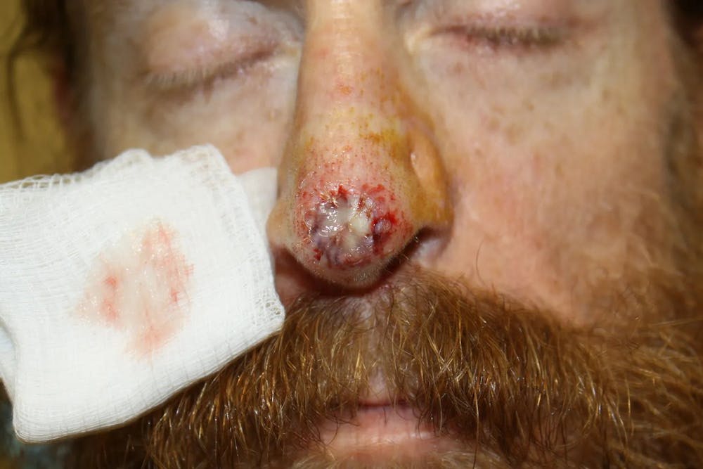 Facial and MOHS Reconstruction Before & After Gallery - Patient 5800758 - Image 2