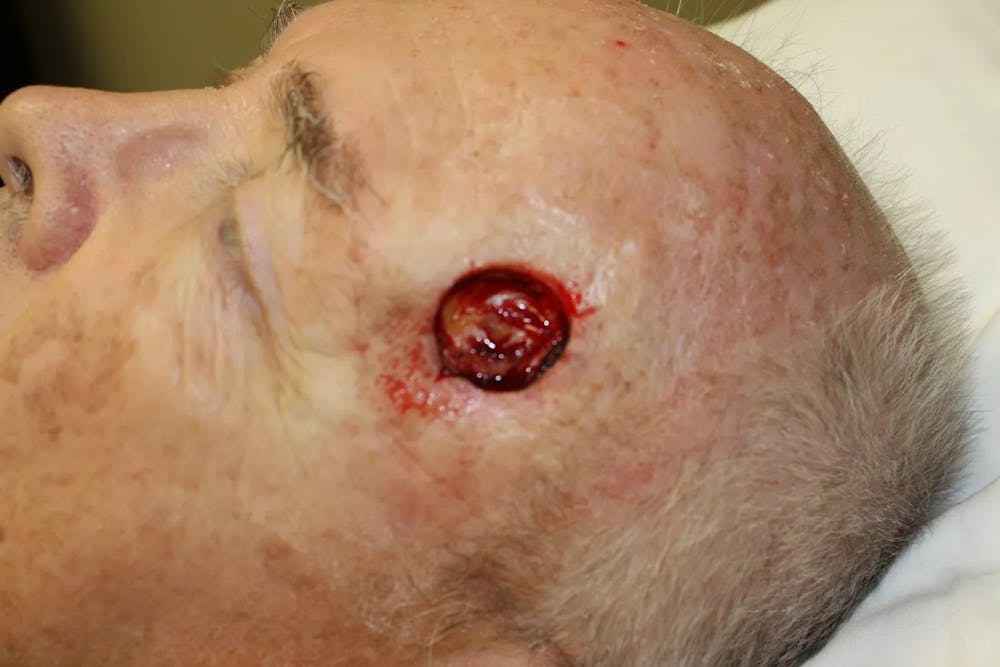 Facial and MOHS Reconstruction Before & After Gallery - Patient 5800759 - Image 2