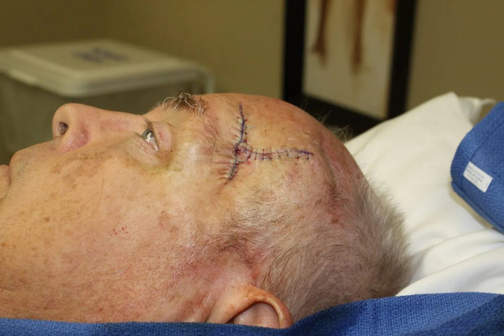 Facial and MOHS Reconstruction Before & After Gallery - Patient 5800759 - Image 3