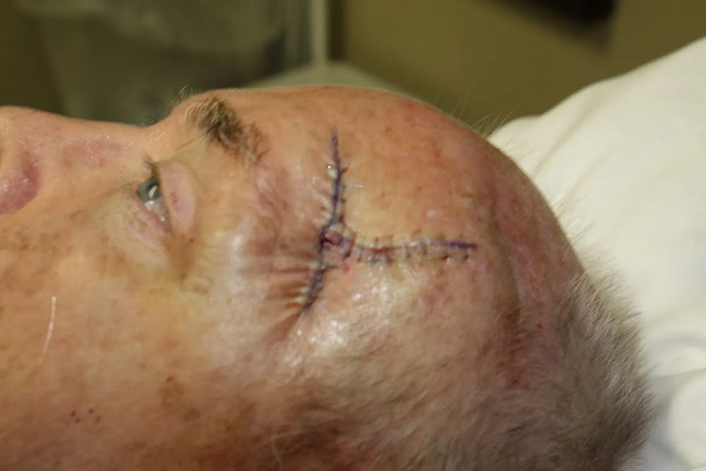 Facial and MOHS Reconstruction Before & After Gallery - Patient 5800759 - Image 4