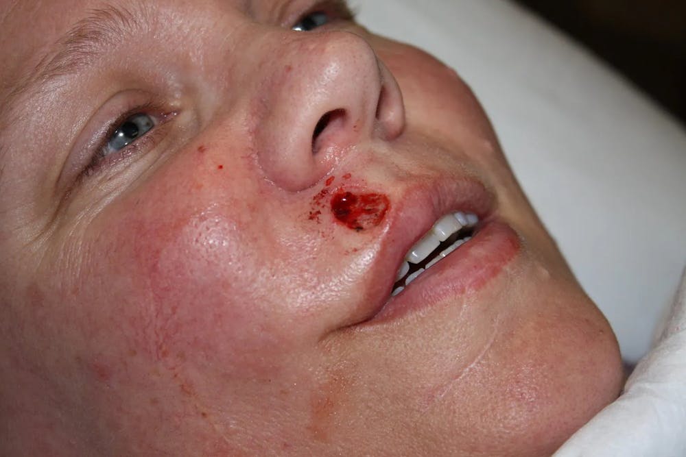 Facial and MOHS Reconstruction Before & After Gallery - Patient 5800760 - Image 1