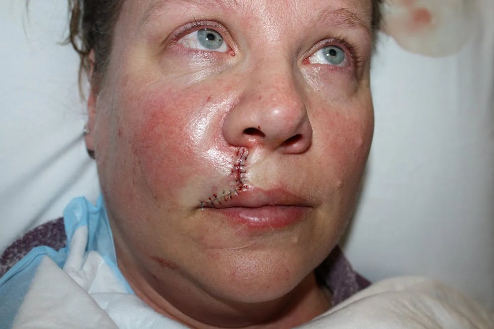 Facial and MOHS Reconstruction Before & After Gallery - Patient 5800760 - Image 2