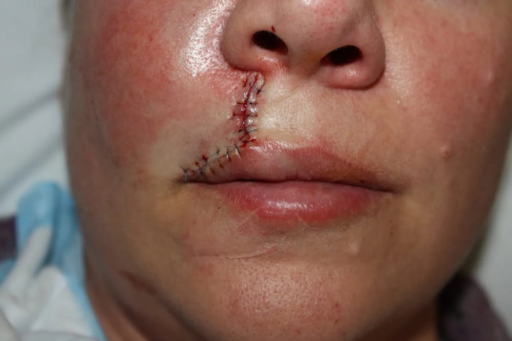 Facial and MOHS Reconstruction Before & After Gallery - Patient 5800760 - Image 3