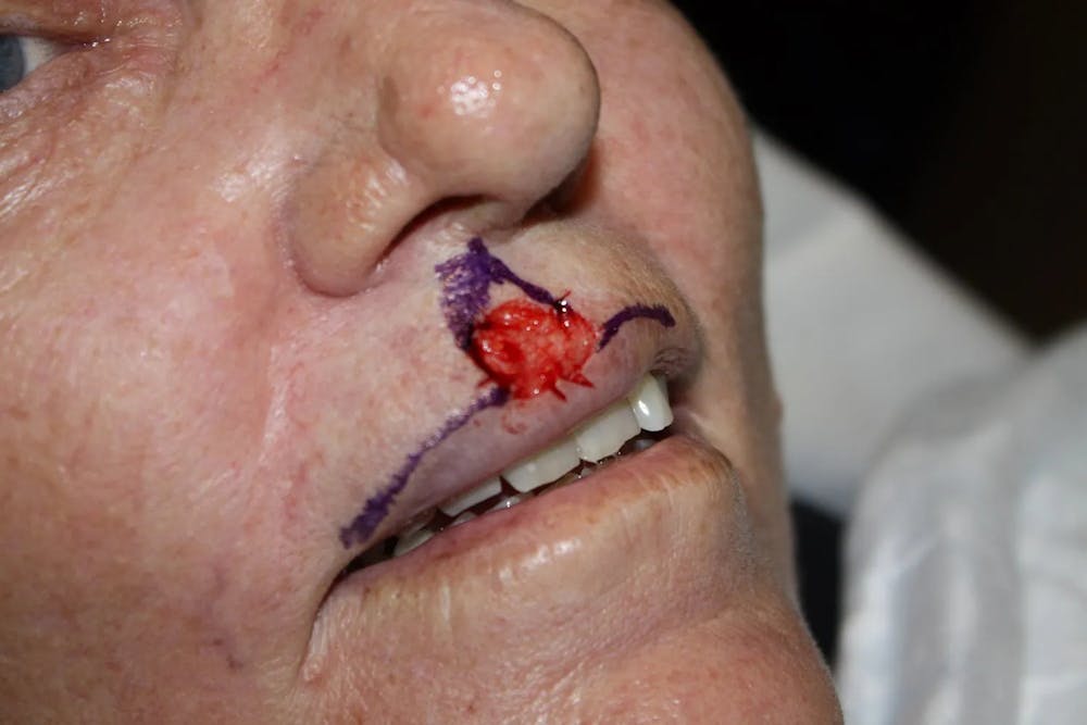 Facial and MOHS Reconstruction Before & After Gallery - Patient 5800761 - Image 1