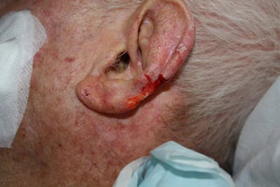 Facial and MOHS Reconstruction Before & After Gallery - Patient 5800762 - Image 1