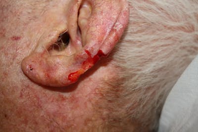 Facial and MOHS Reconstruction Before & After Gallery - Patient 5800762 - Image 2