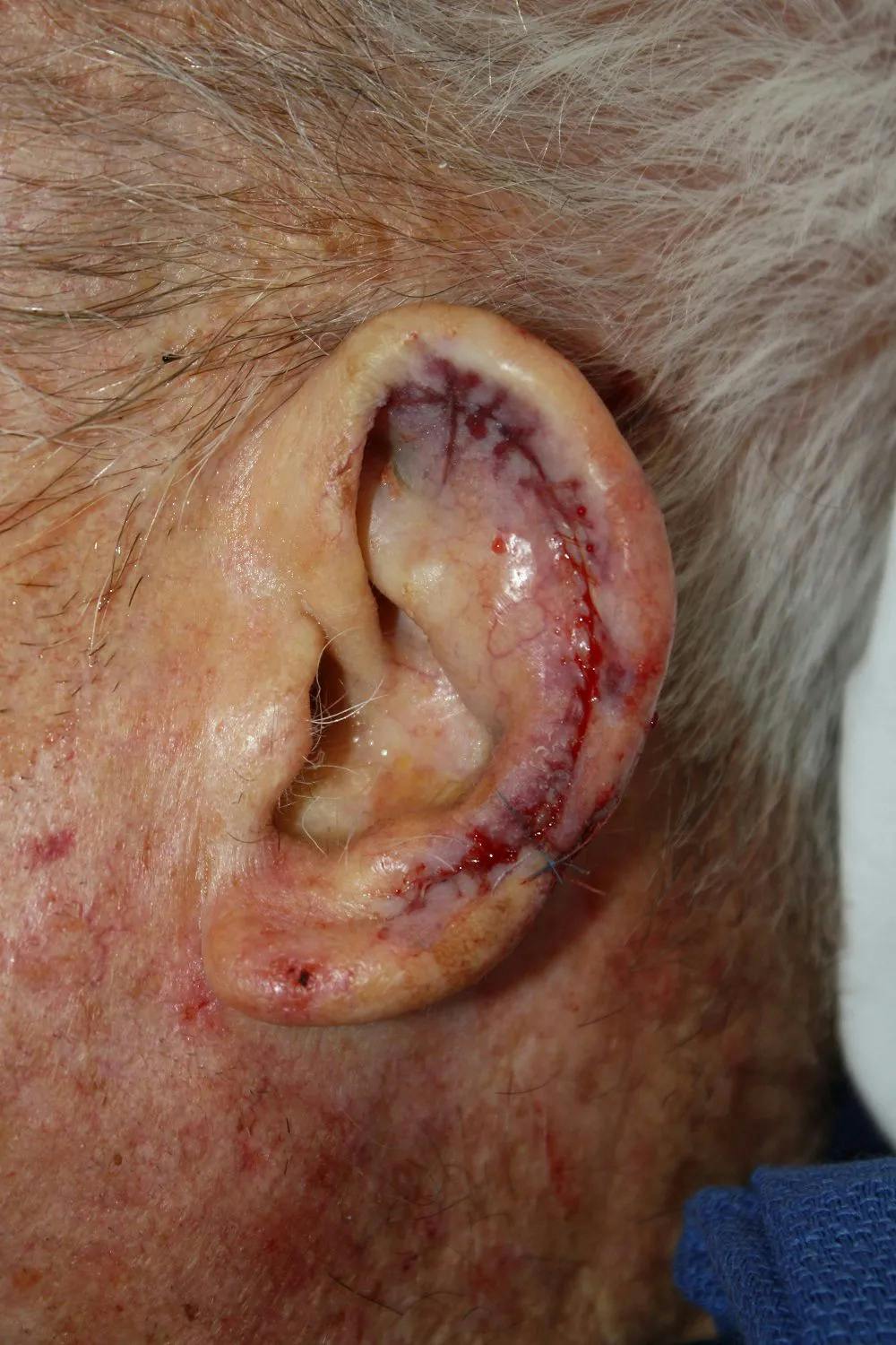 Facial and MOHS Reconstruction Before & After Gallery - Patient 5800762 - Image 3