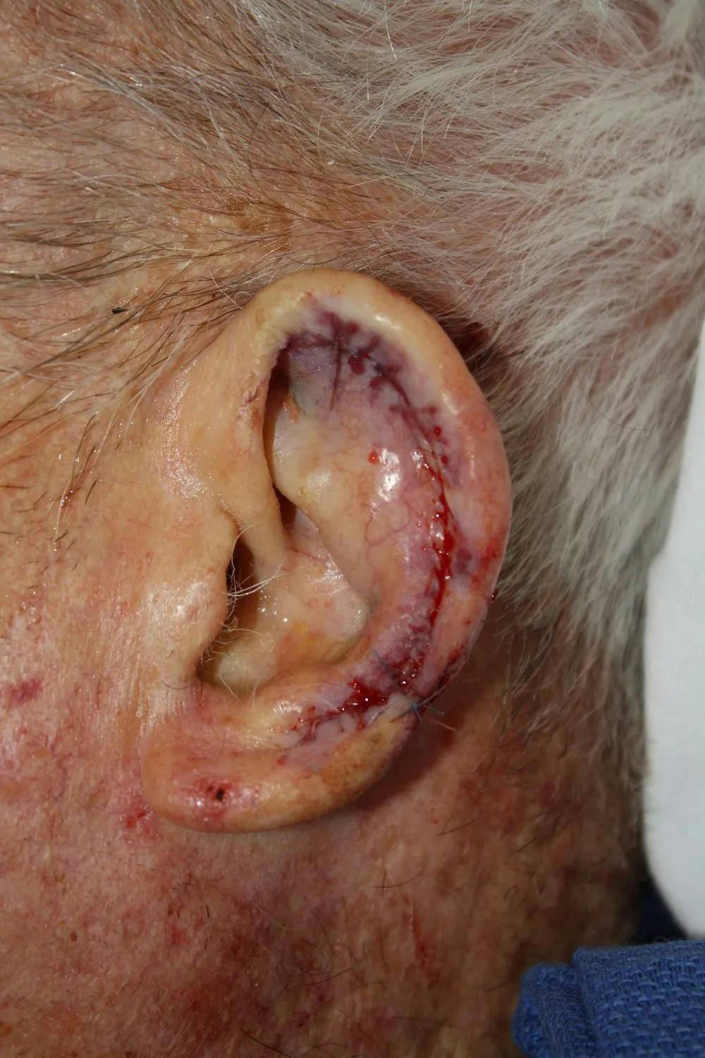 Facial and MOHS Reconstruction Before & After Gallery - Patient 5800762 - Image 4