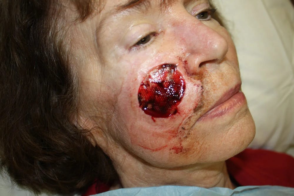 Facial and MOHS Reconstruction Before & After Gallery - Patient 5800763 - Image 1