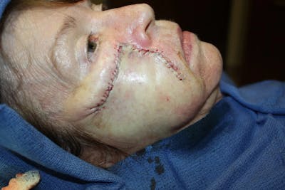 Facial and MOHS Reconstruction Before & After Gallery - Patient 5800763 - Image 2
