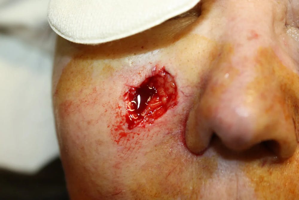 Facial and MOHS Reconstruction Before & After Gallery - Patient 5800764 - Image 1