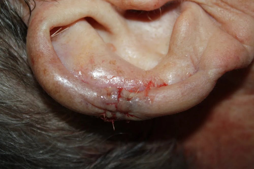 Facial and MOHS Reconstruction Before & After Gallery - Patient 5800765 - Image 2