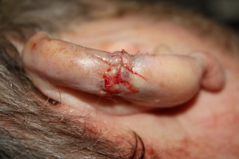 Facial and MOHS Reconstruction Before & After Gallery - Patient 5800765 - Image 3