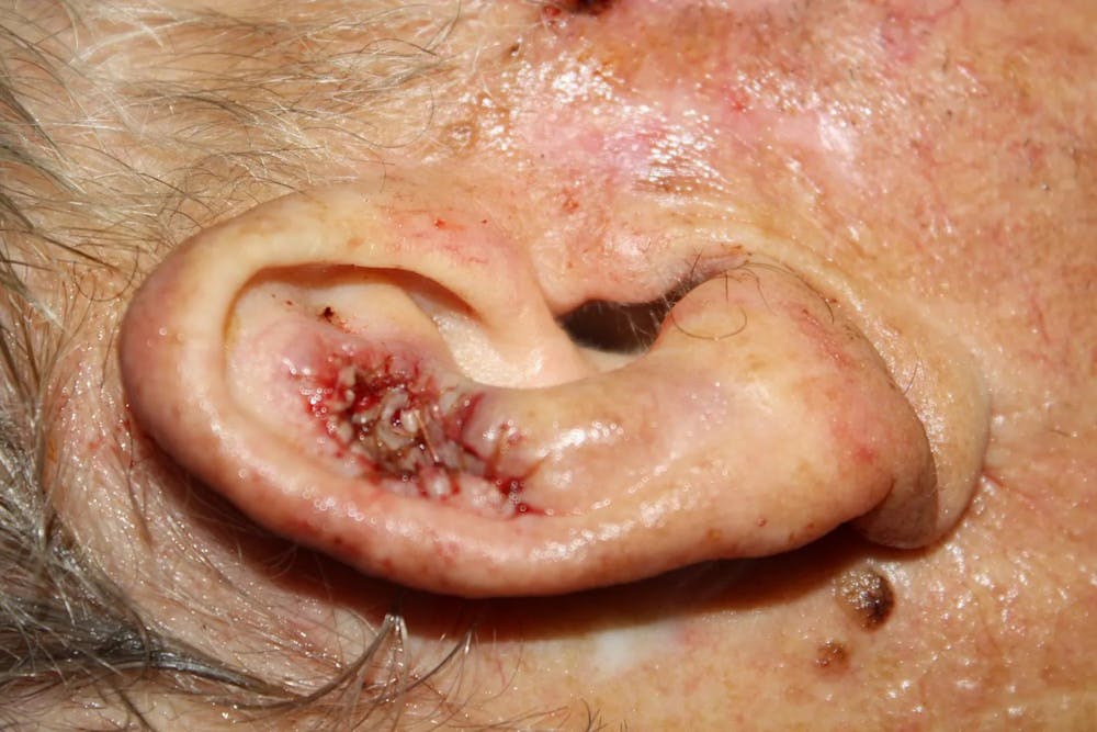 Facial and MOHS Reconstruction Before & After Gallery - Patient 5800766 - Image 2