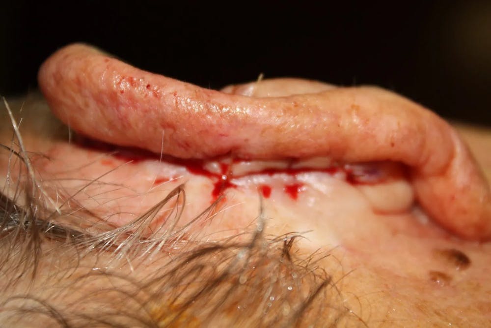 Facial and MOHS Reconstruction Before & After Gallery - Patient 5800766 - Image 3