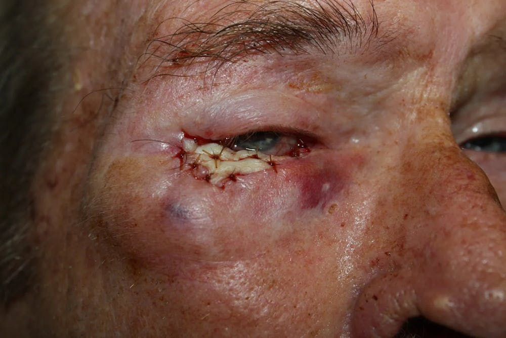 Facial and MOHS Reconstruction Before & After Gallery - Patient 5800767 - Image 2