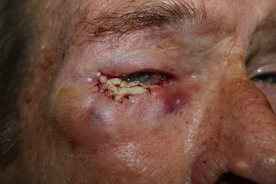 Facial and MOHS Reconstruction Before & After Gallery - Patient 5800767 - Image 2