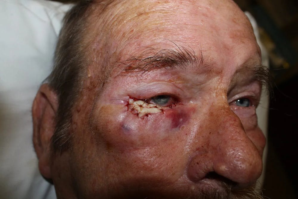 Facial and MOHS Reconstruction Before & After Gallery - Patient 5800767 - Image 3