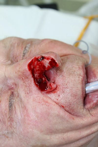 Facial and MOHS Reconstruction Before & After Gallery - Patient 5800768 - Image 2