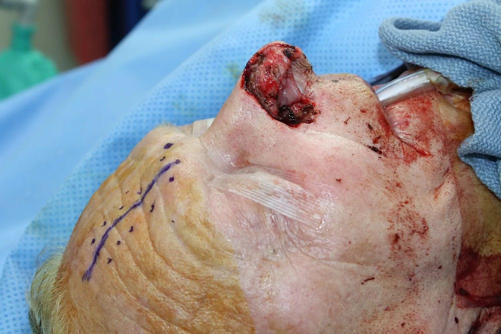 Facial and MOHS Reconstruction Before & After Gallery - Patient 5800768 - Image 4