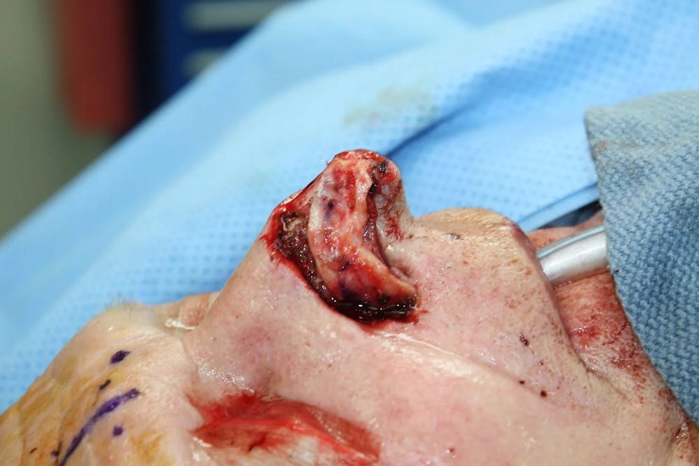 Facial and MOHS Reconstruction Before & After Gallery - Patient 5800768 - Image 5