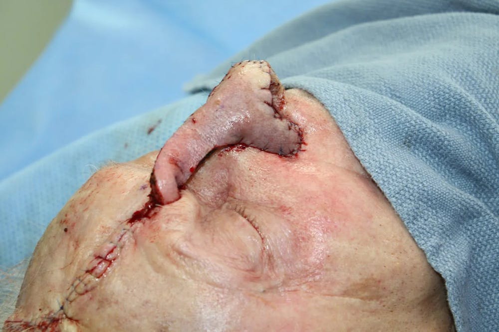 Facial and MOHS Reconstruction Before & After Gallery - Patient 5800768 - Image 6