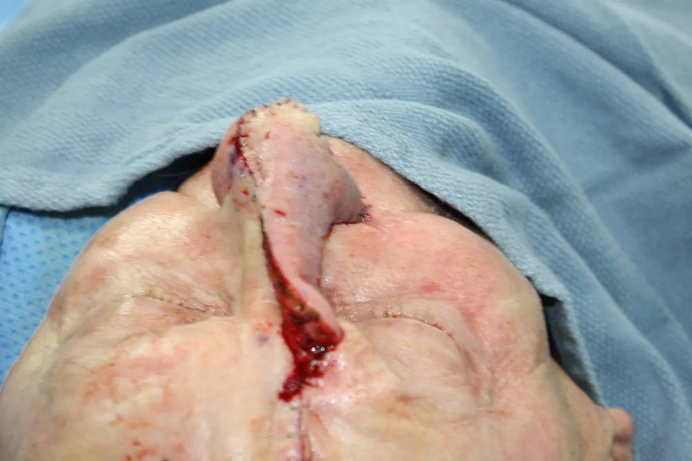 Facial and MOHS Reconstruction Before & After Gallery - Patient 5800768 - Image 7
