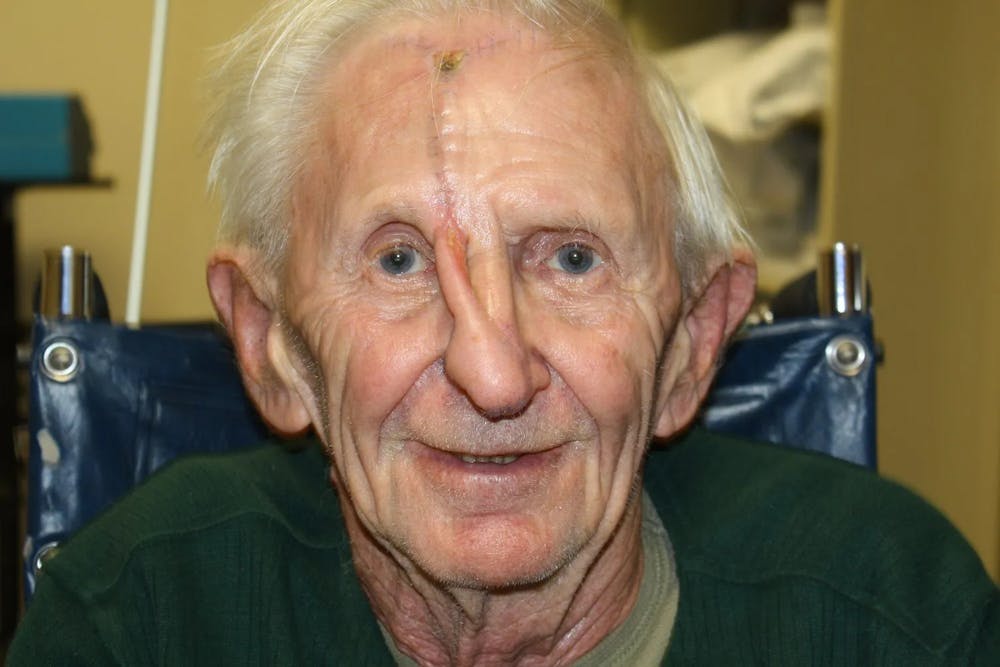 Facial and MOHS Reconstruction Before & After Gallery - Patient 5800768 - Image 8